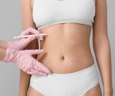 Abdominoplasty