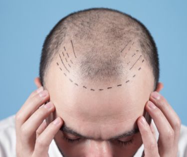 Hair Transplantation